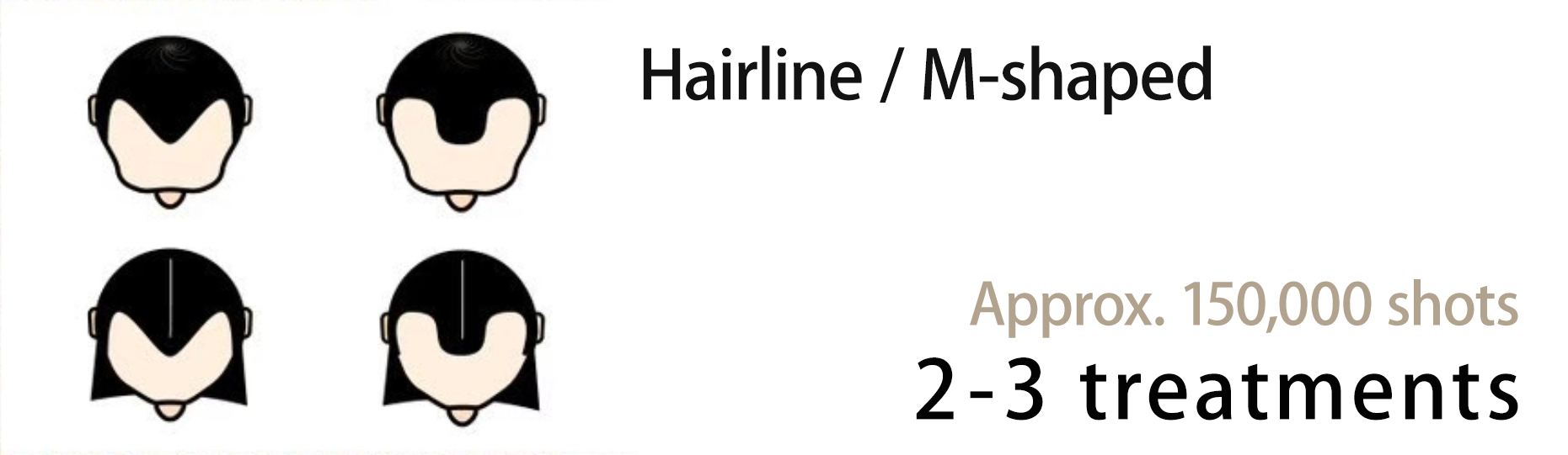Hairline / M-shapedApprox. 150,000 shots2-3 treatments