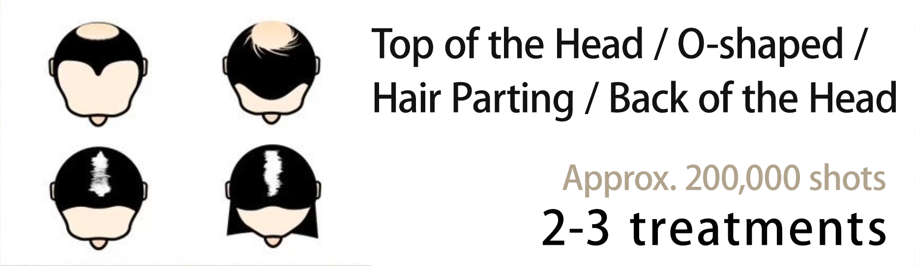 Top of the Head / O-shaped / Hair Parting / Back of the HeadApprox. 200,000 shots2-3 treatments