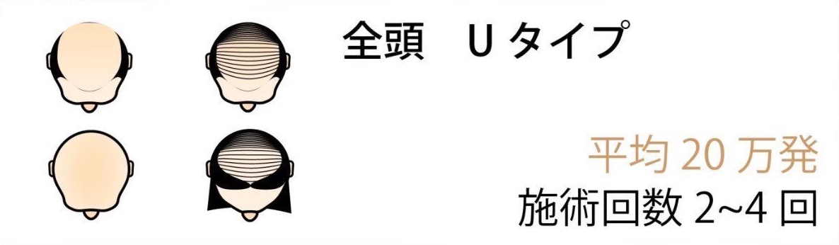 全頭 Uタイプスキンヘッド 平均40万発 施術回数 3~5回