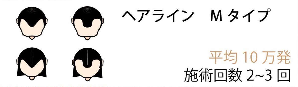 ヘアライン Mタイプ 平均15万発 施術回数 2~3回