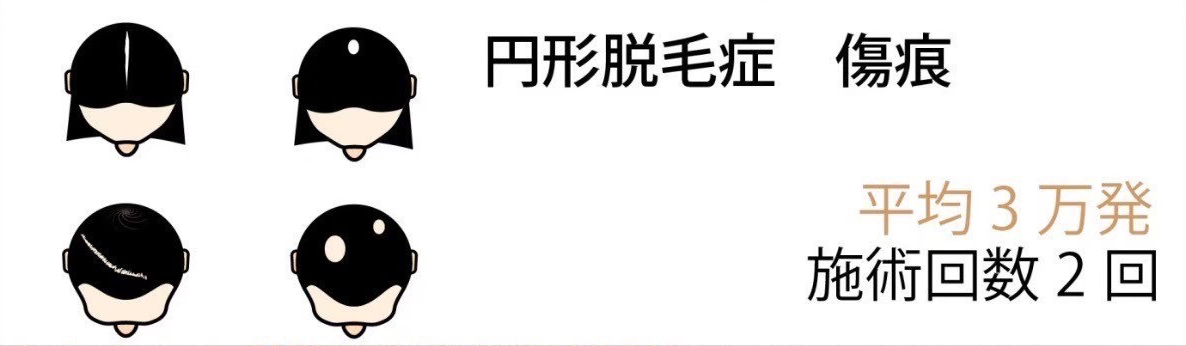 円形脱毛症　傷痕 平均5万発 施術回数 1~2回
